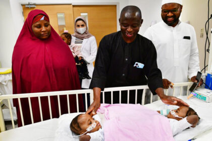 Nigerian Conjoined Twins Successfully Separated